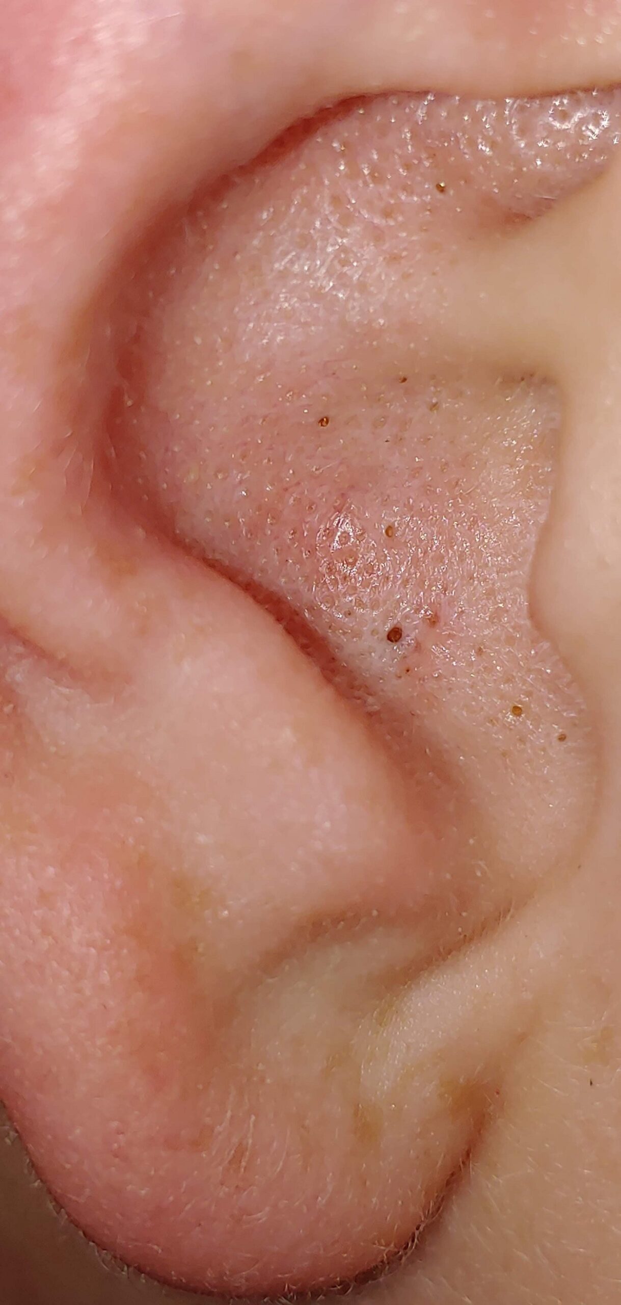 Remove Big Blackheads