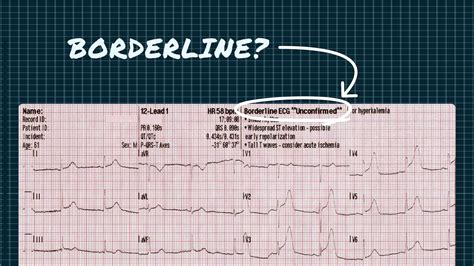 5 Borderline EKG Signs
