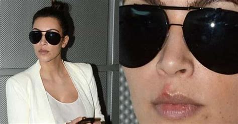 Celebrities With Herpes Famous People With Herpes Men Celebrities With Herpes Famous People With Herpes Men