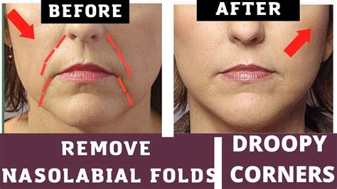 5 Ways Fix Droop