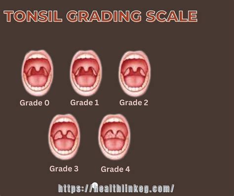5 Ways Grade Tonsils