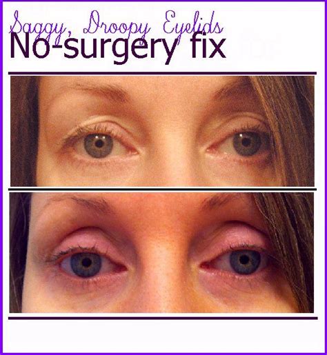How To Fix Droopy Eyelids Without Surgery How To Fix Droopy Eyelids Without Surgery