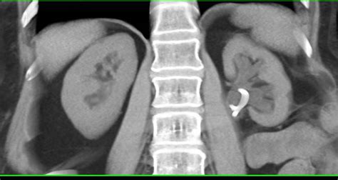 Kidney Cortex Thinning Causes