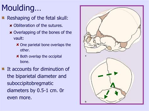 5 Ways Molding Occiput