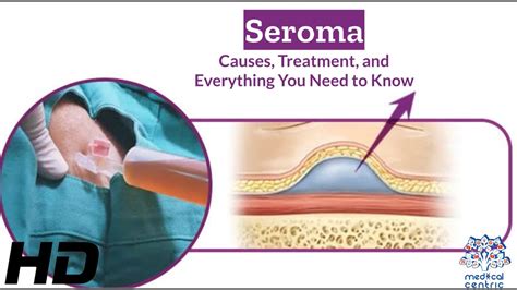 Seroma Breakdown Causes Treatment Options And Essential Tips Youtube Seroma Breakdown Causes Treatment Options And Essential Tips Youtube