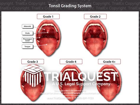 Tonsil Grading System Guide
